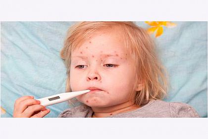 Корь возвращается в Украину