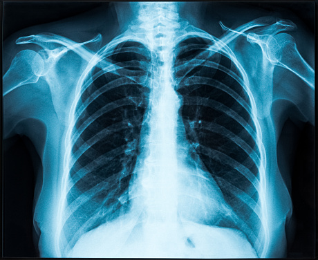 Україна оновила стандарти медичної допомоги при туберкульозі