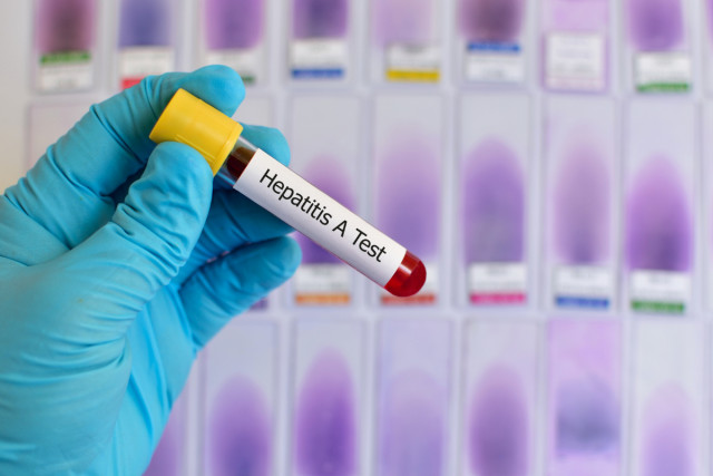 Спалах гепатиту А на Вінниччині: прогнозують ще одну хвилю захворюваності