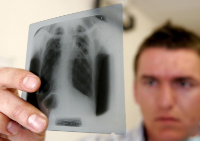 Больных туберкулезом госпитализируют в принудительном порядке
