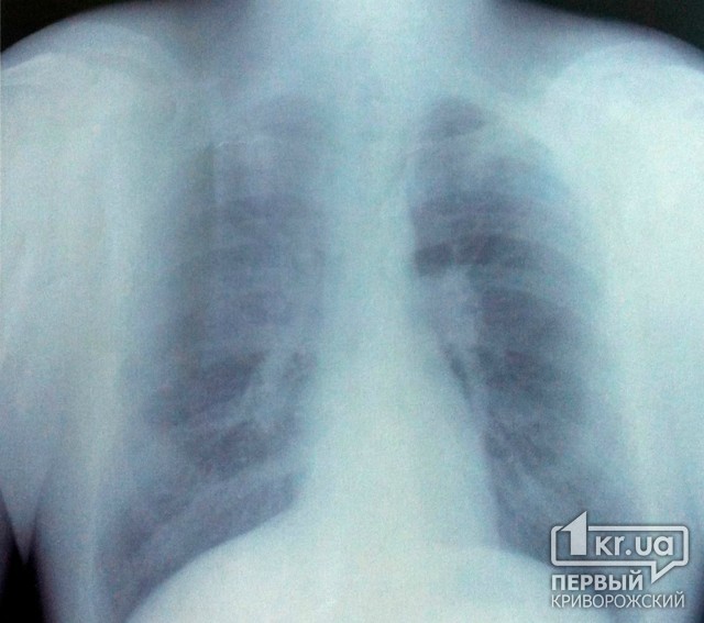 Туберкулез - не приговор: Как уберечь себя от болезни?