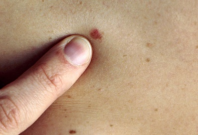 Уже 72 криворожанина заболели раком кожи в 2012 году
