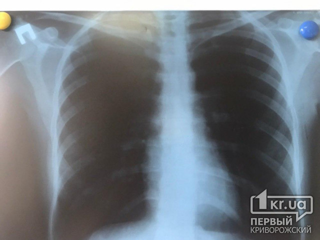 Восьмерых пациентов с пневмонией в Кривом Роге госпитализировали за минувшие сутки