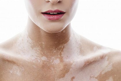 За прошлый год в Кривом Роге зарегистрировали 23 случая витилиго