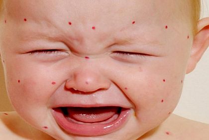 267 криворожанин заболели корью в 2019 году