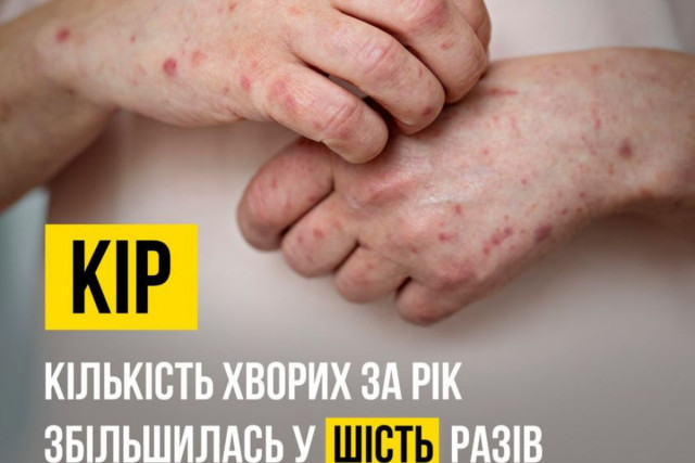 Кількість хворих в Україні на кір за рік збільшилась у 6 разів