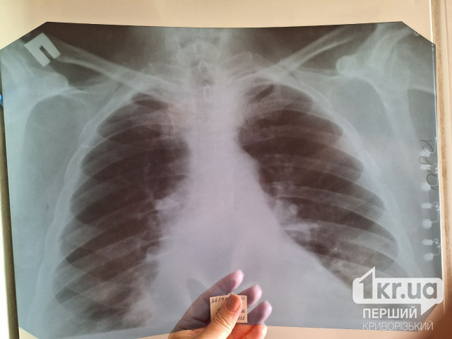 У Кривому Розі з початку року зафіксували 102 випадки захворювання на туберкульоз