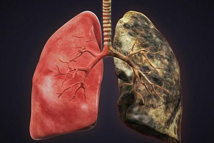 Чому виникає рак легень і як захистити себе