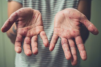 Чем опасен вирус Коксаки и как криворожанам уберечься от него