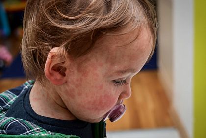 На Днепропетровщине корью заболели 7 человек: среди них — непривитые дети