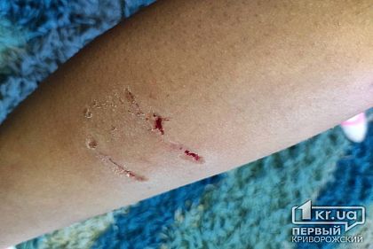 В Кривом Роге на ребенка напала стая собак